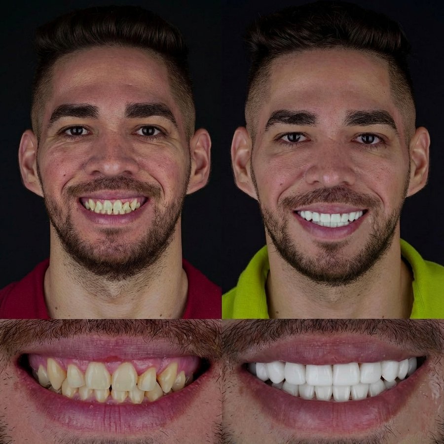 Smile design with Porcelain Veneers