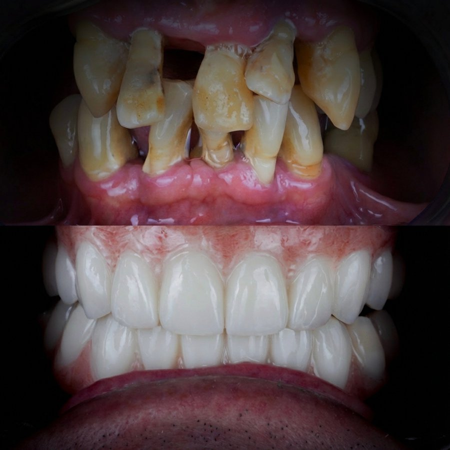 Hybrid Denture (top and bottom)