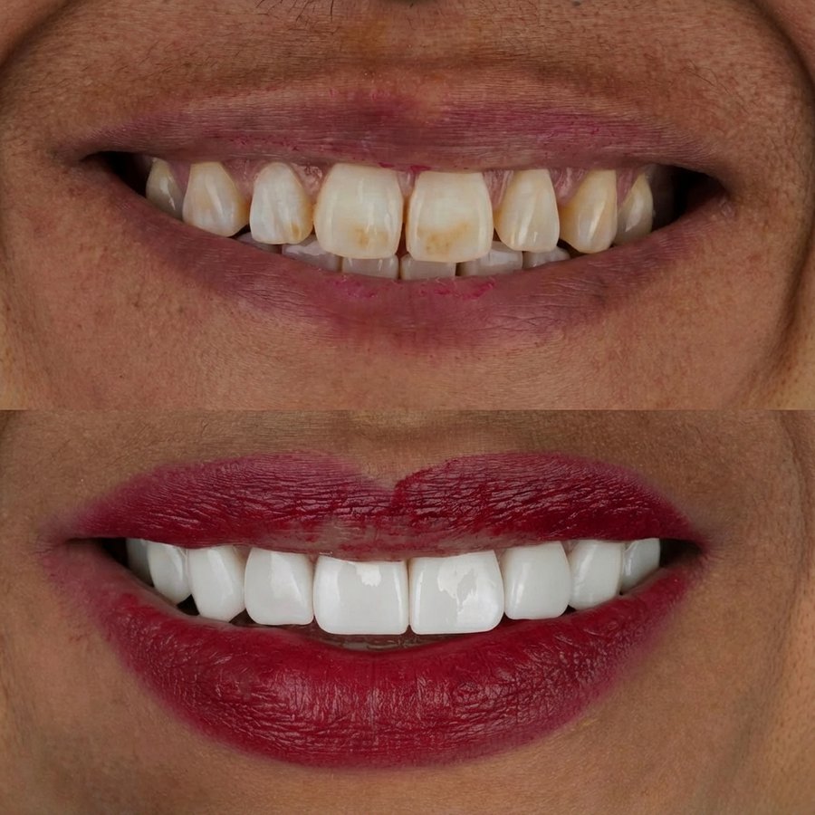 Smile design with Porcelain Veneers