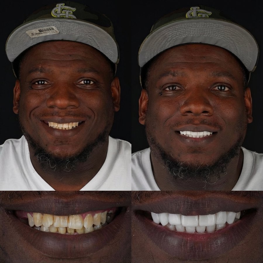 Smile Design with Porcelain Veneers
