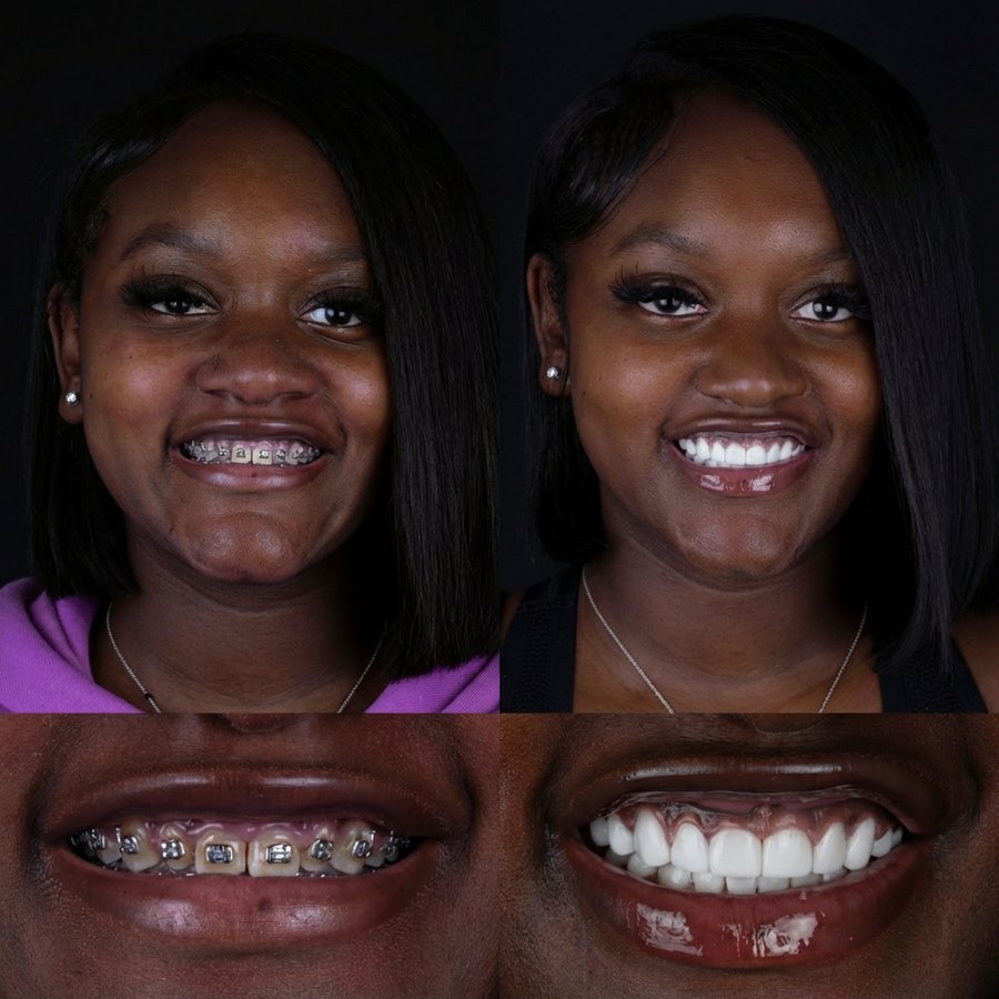 Smile Design with Porcelain Veneers