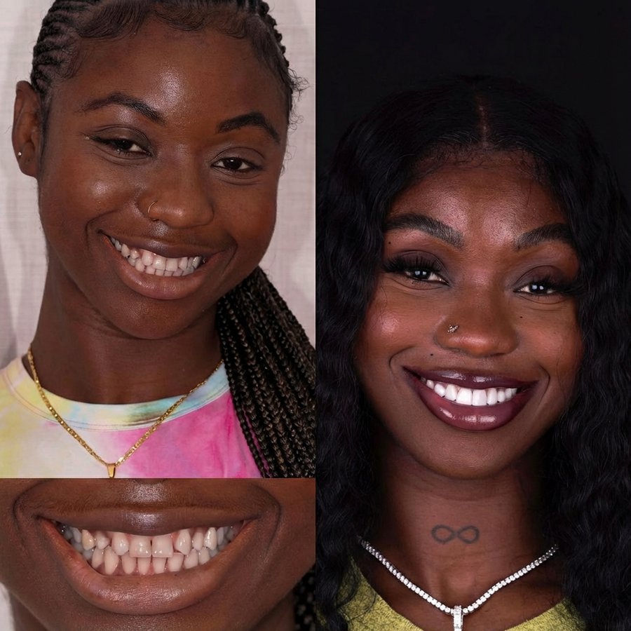 Smile Design with Porcelain Veneers