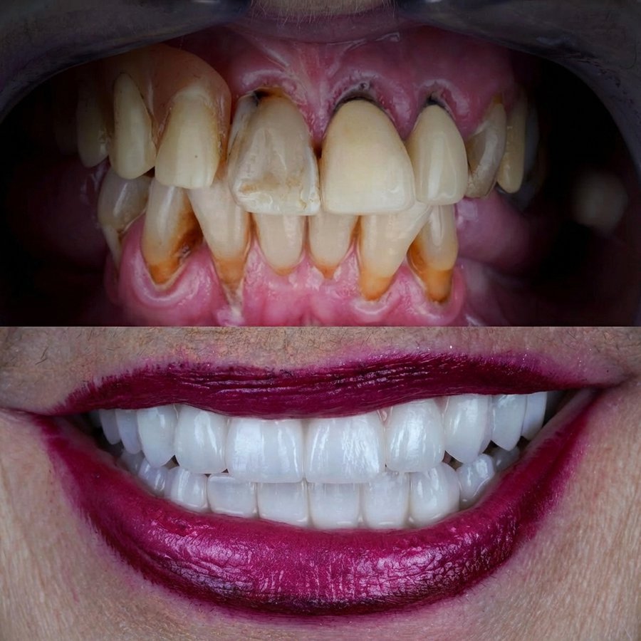 Hybrid Denture (top and bottom)