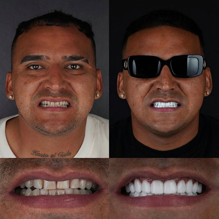 Smile Design with Porcelain Veneers