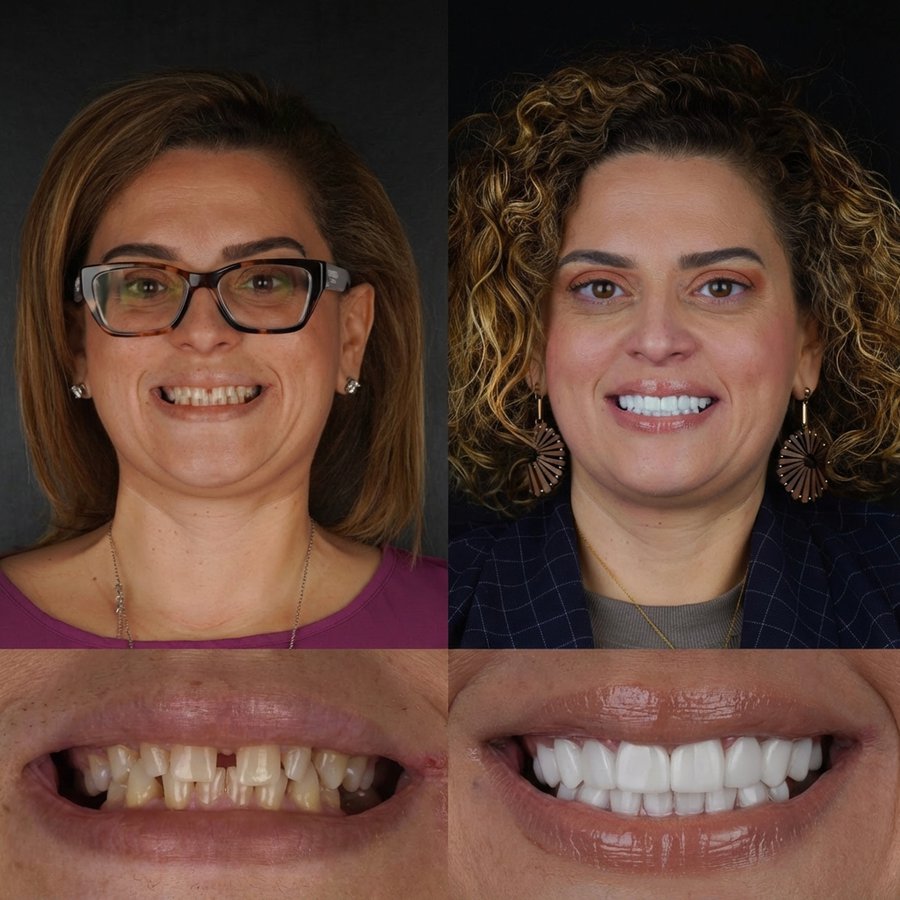 Smile Design with Porcelain Veneers
