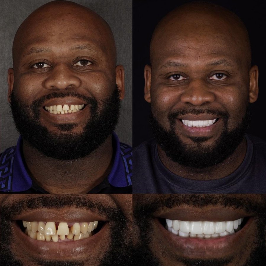 Smile Design with Porcelain Veneers