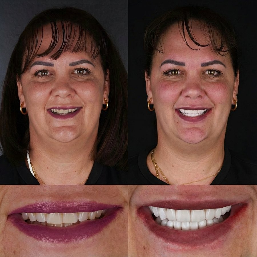 Smile Design with Porcelain Veneers