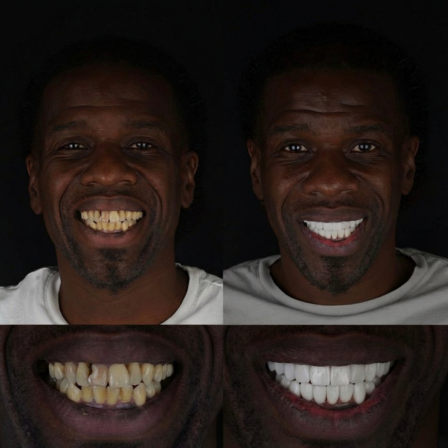 Smile Design with Porcelain Veneers