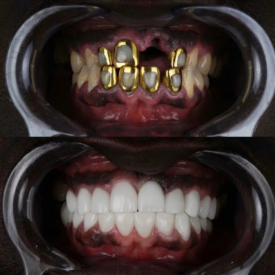 Smile Design with Porcelain Veneers and Implant
