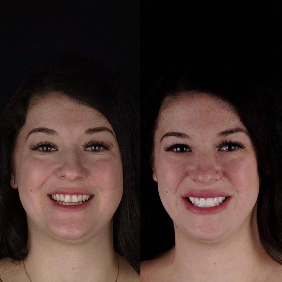 Smile Design with Porcelain Veneers