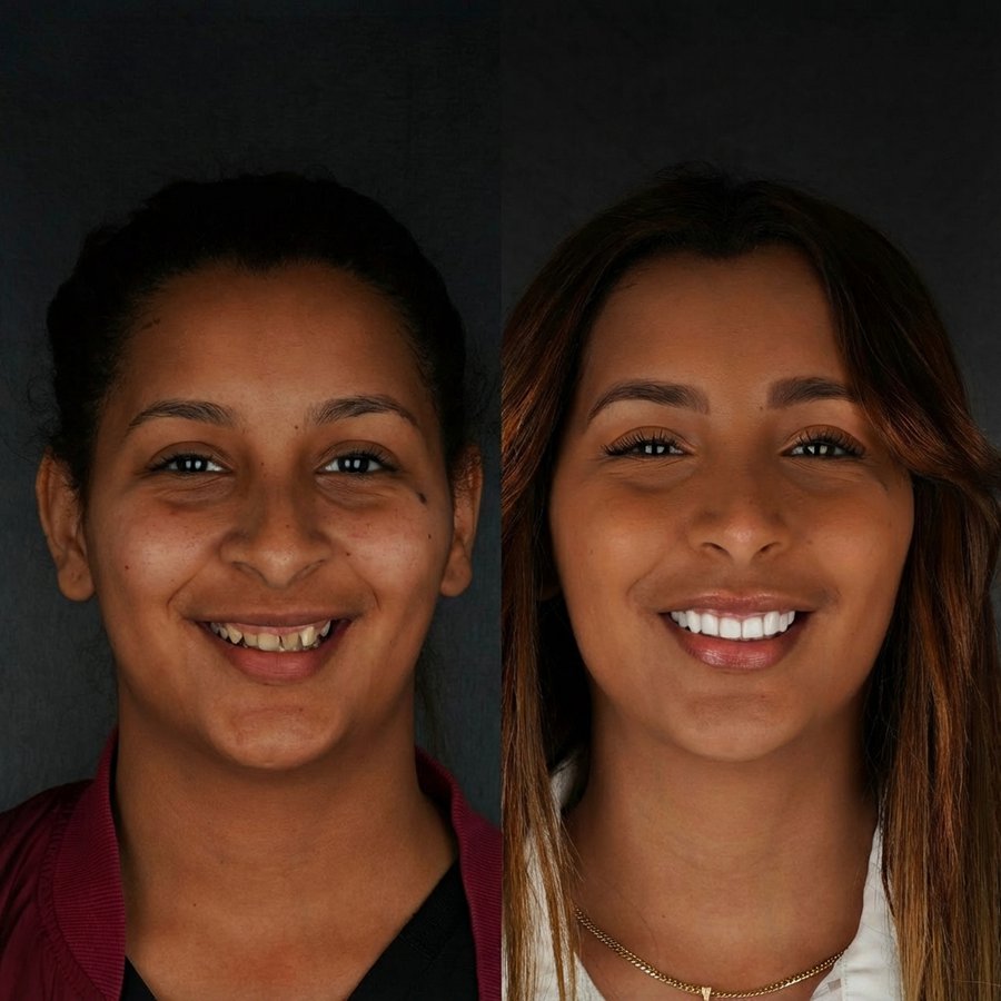 Smile Design with Porcelain Veneers