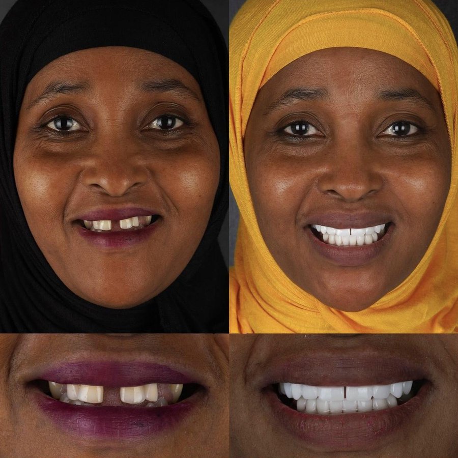 Smile Design with Porcelain Veneers