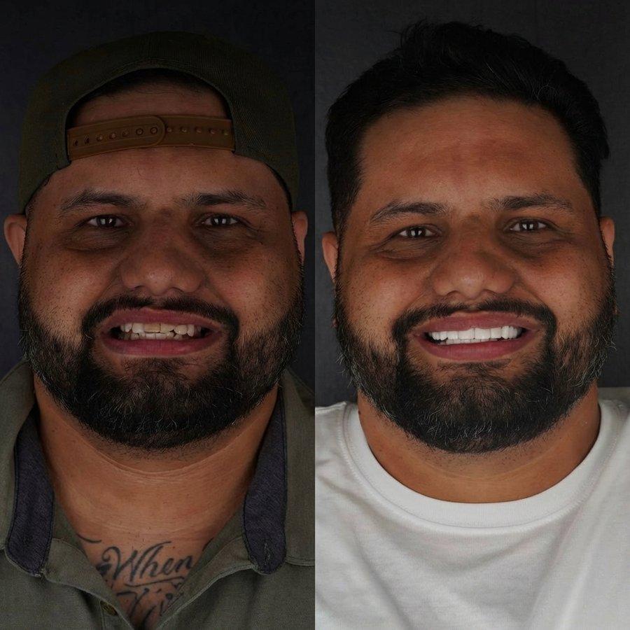 Smile Design with Porcelain Veneers