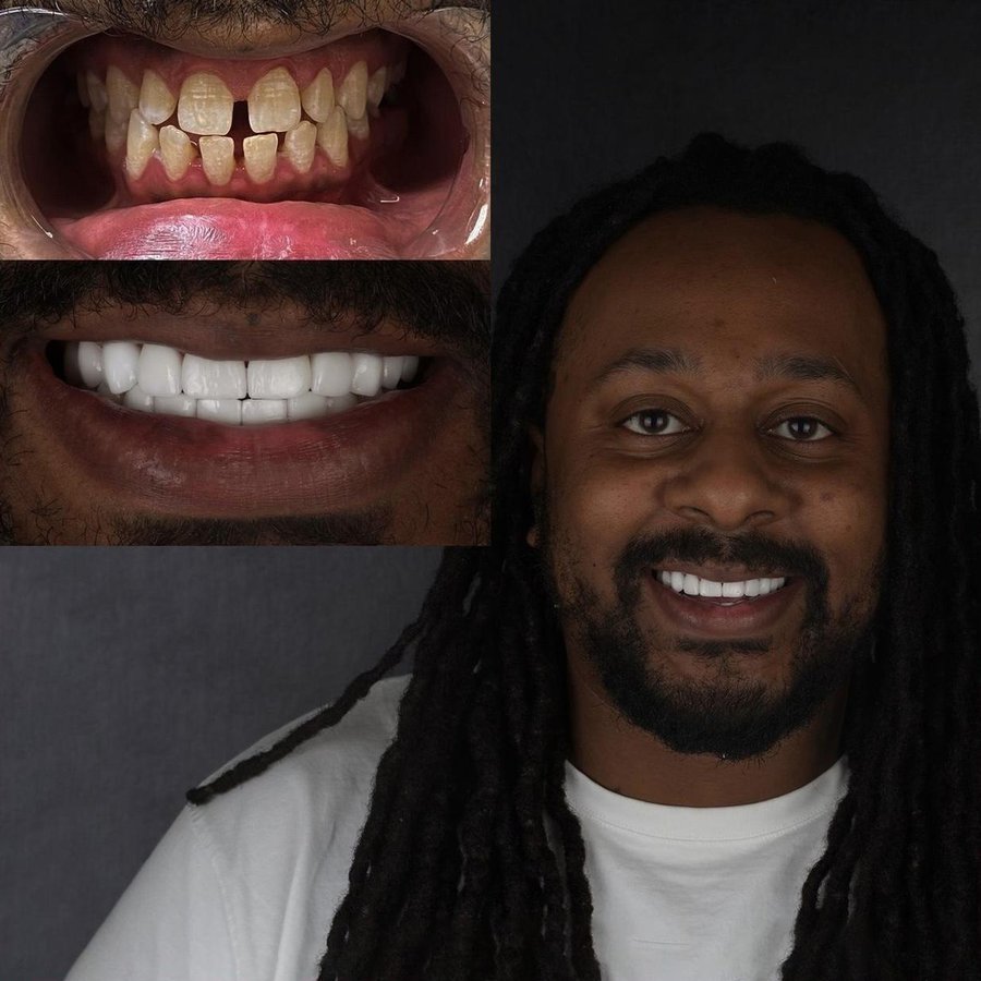 Smile Design with Porcelain Veneers