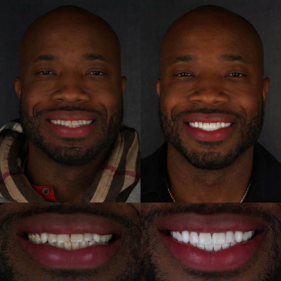 Smile Design with Porcelain Veneers