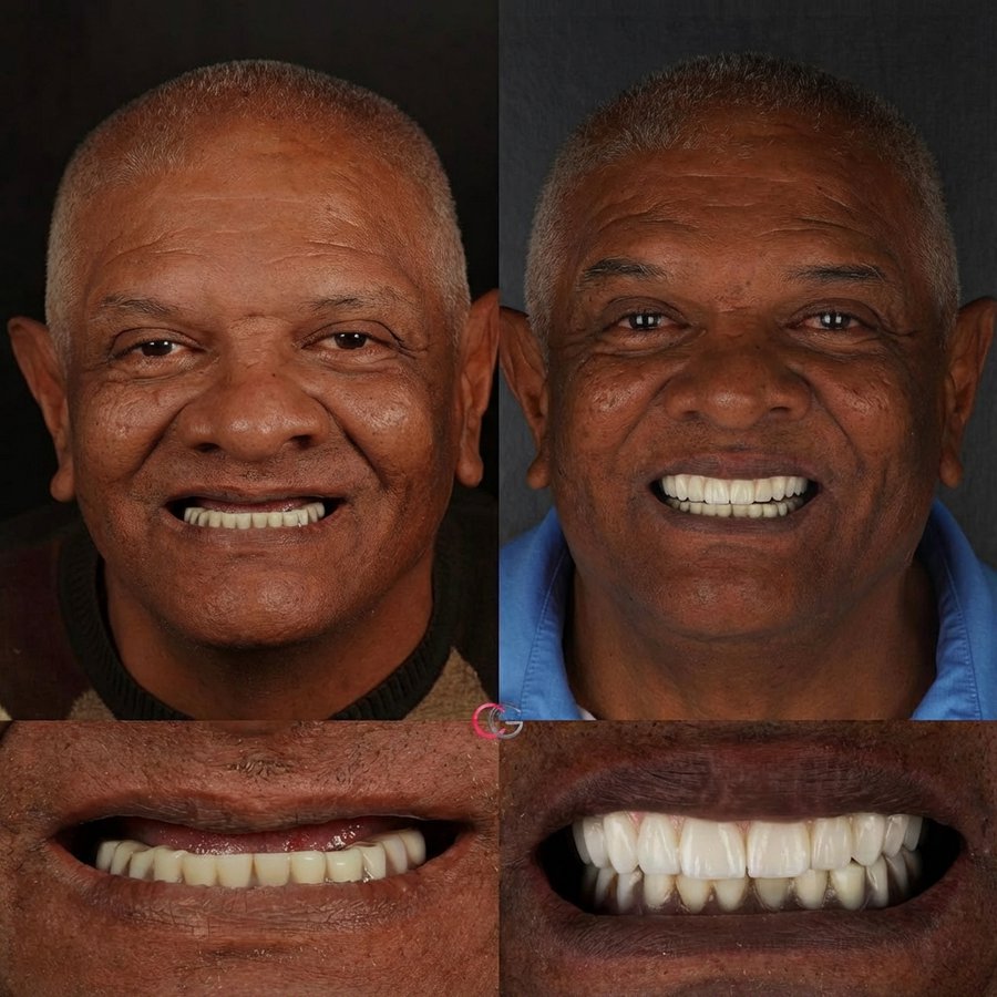 Hybrid Denture (top arch)