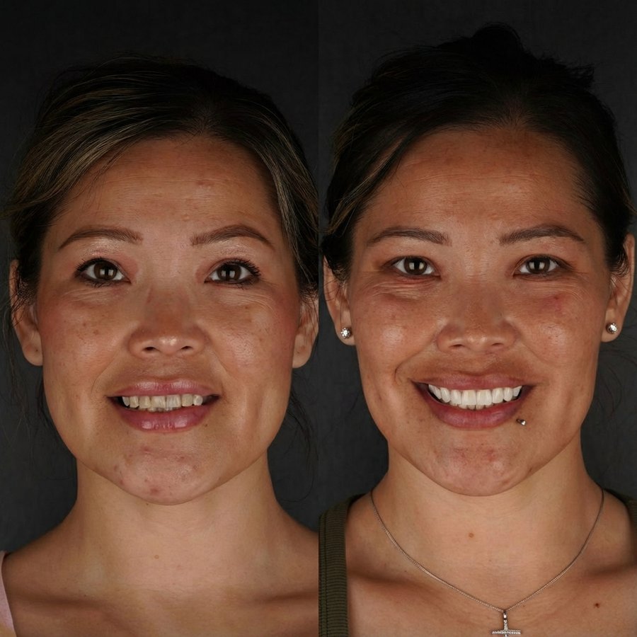 Smile Design with Porcelain Veneers