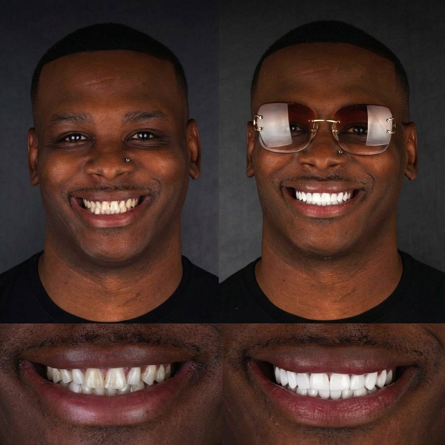 Smile Design with Porcelain Veneers