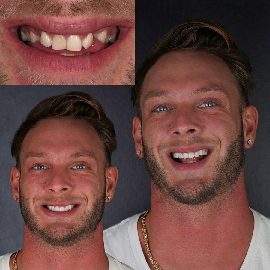 Smile Design with Porcelain Veneers and Dental Implants