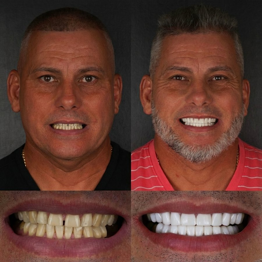 Smile Design with Porcelain Veneers