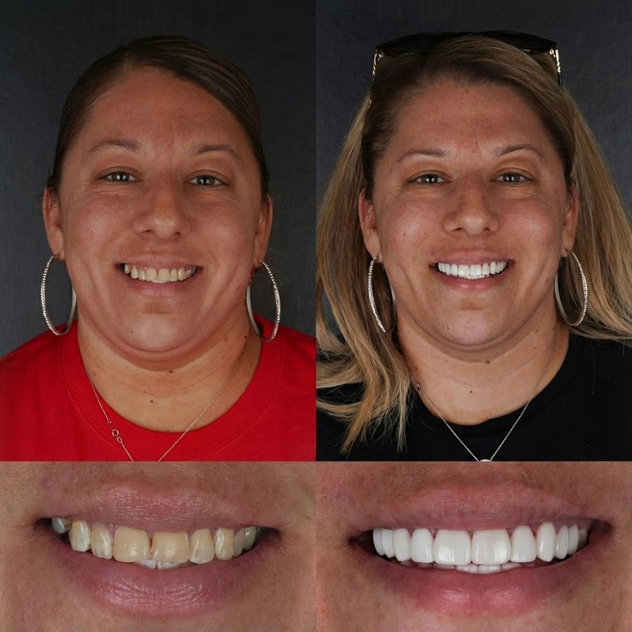 Smile Design with Porcelain Veneers