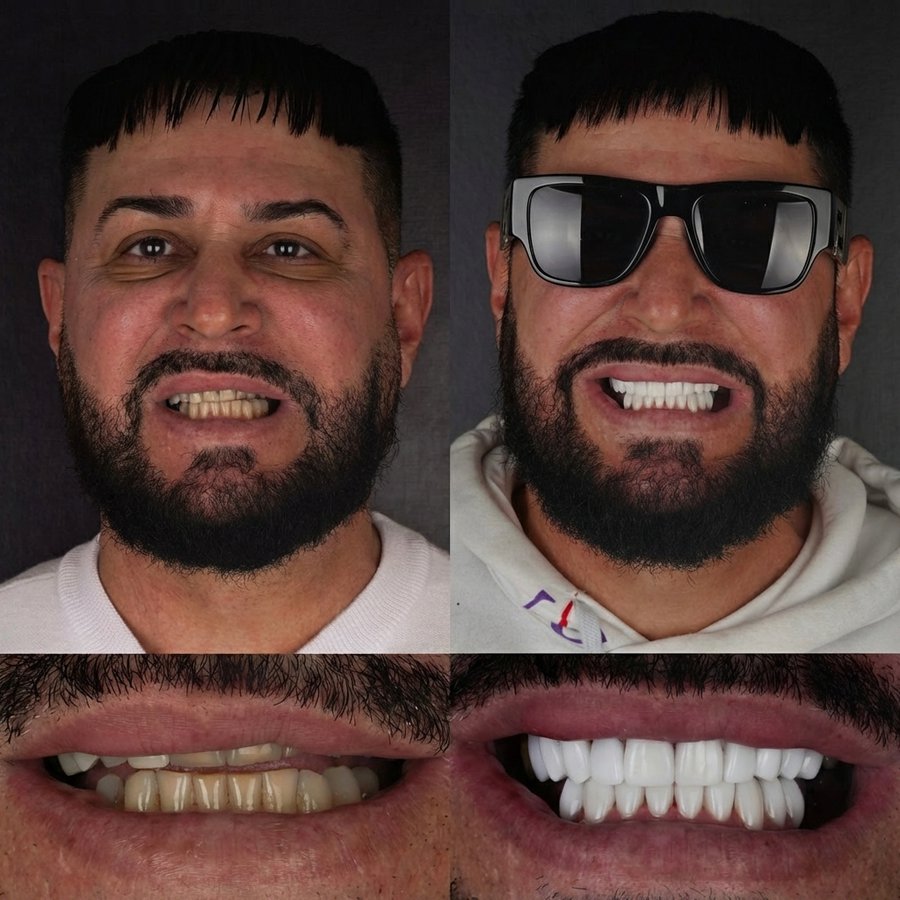 Smile Design with Porcelain Veneers