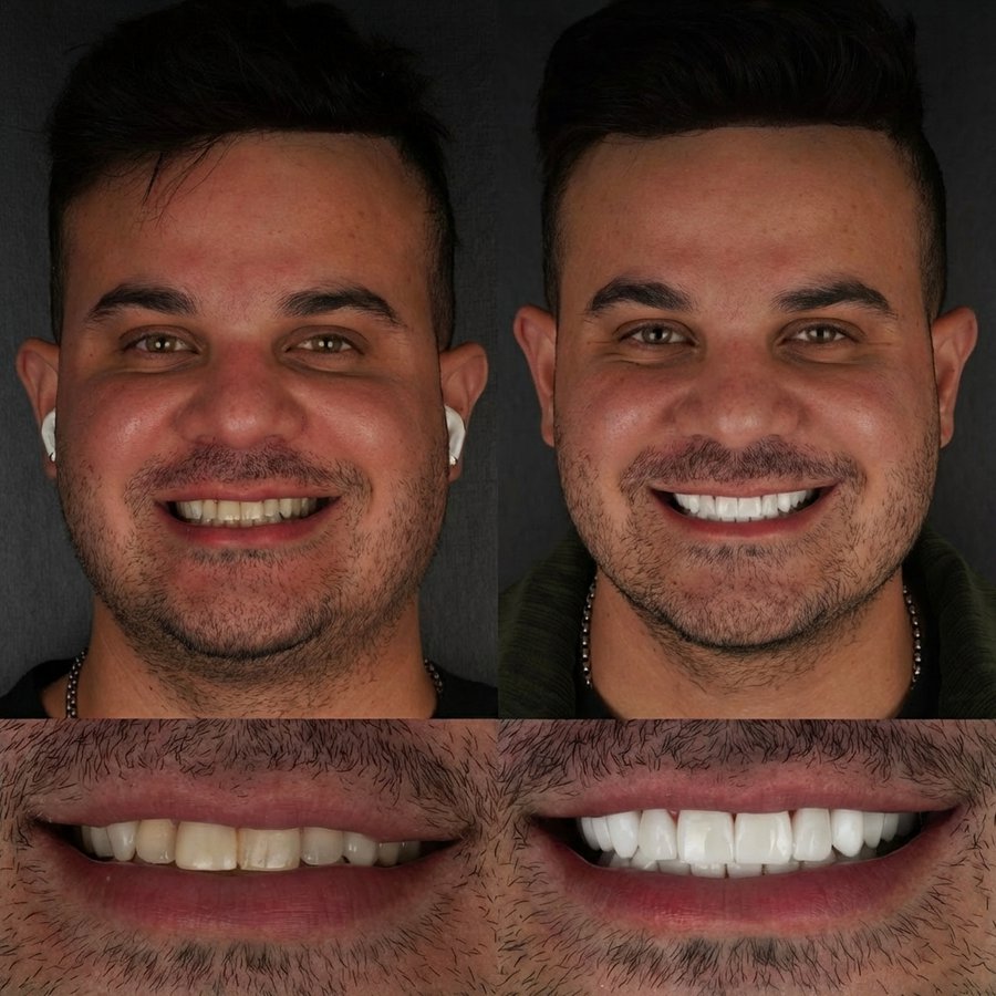 Smile Design with Porcelain Veneers