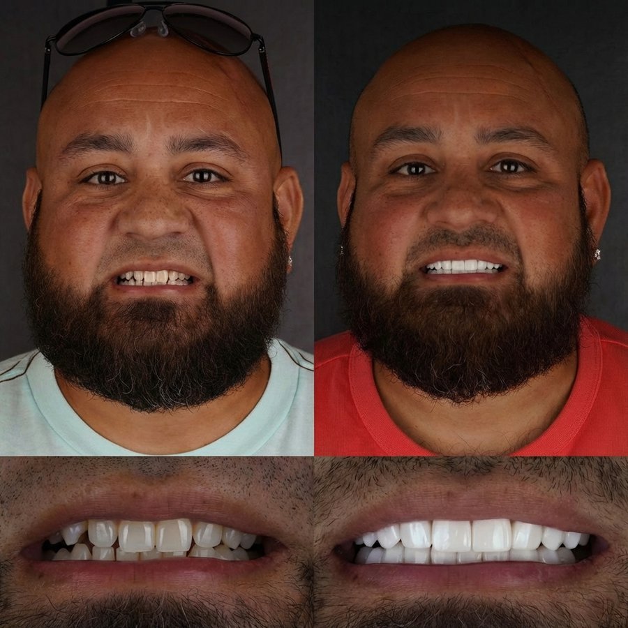 Smile Design with Porcelain Veneers