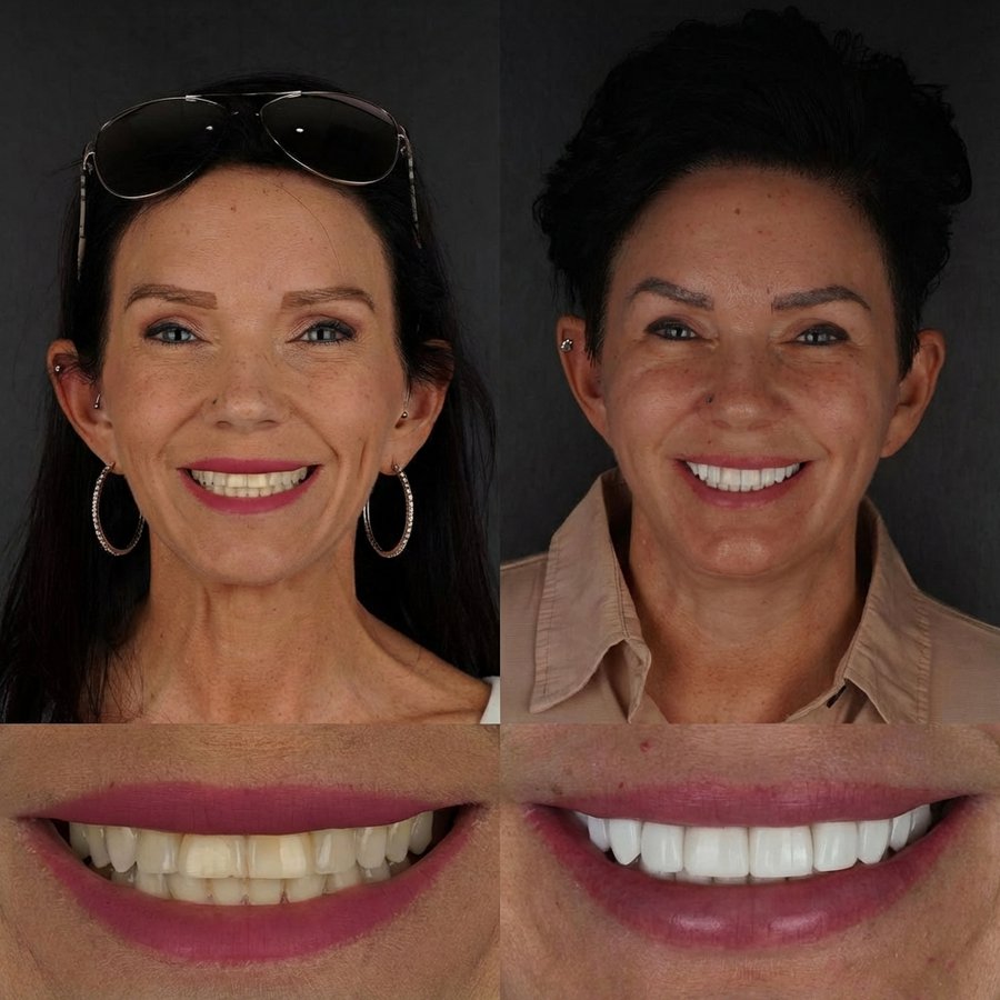 Smile Design with Porcelain Veneers