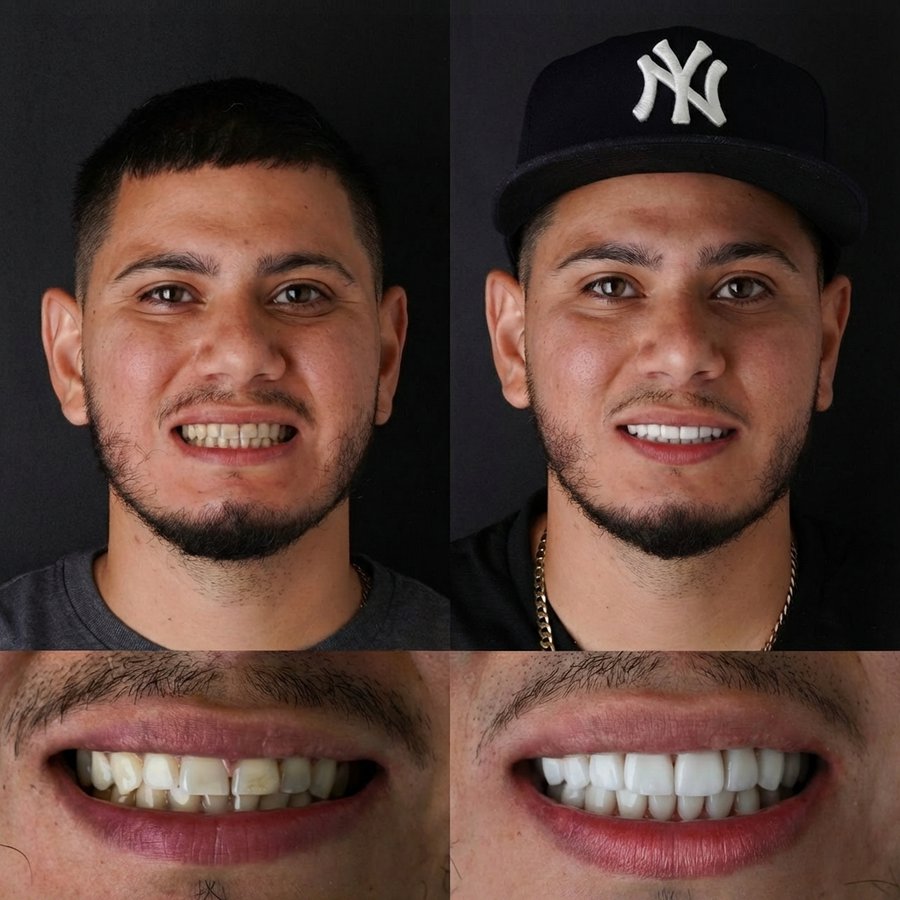 Smile Design with Porcelain Veneers