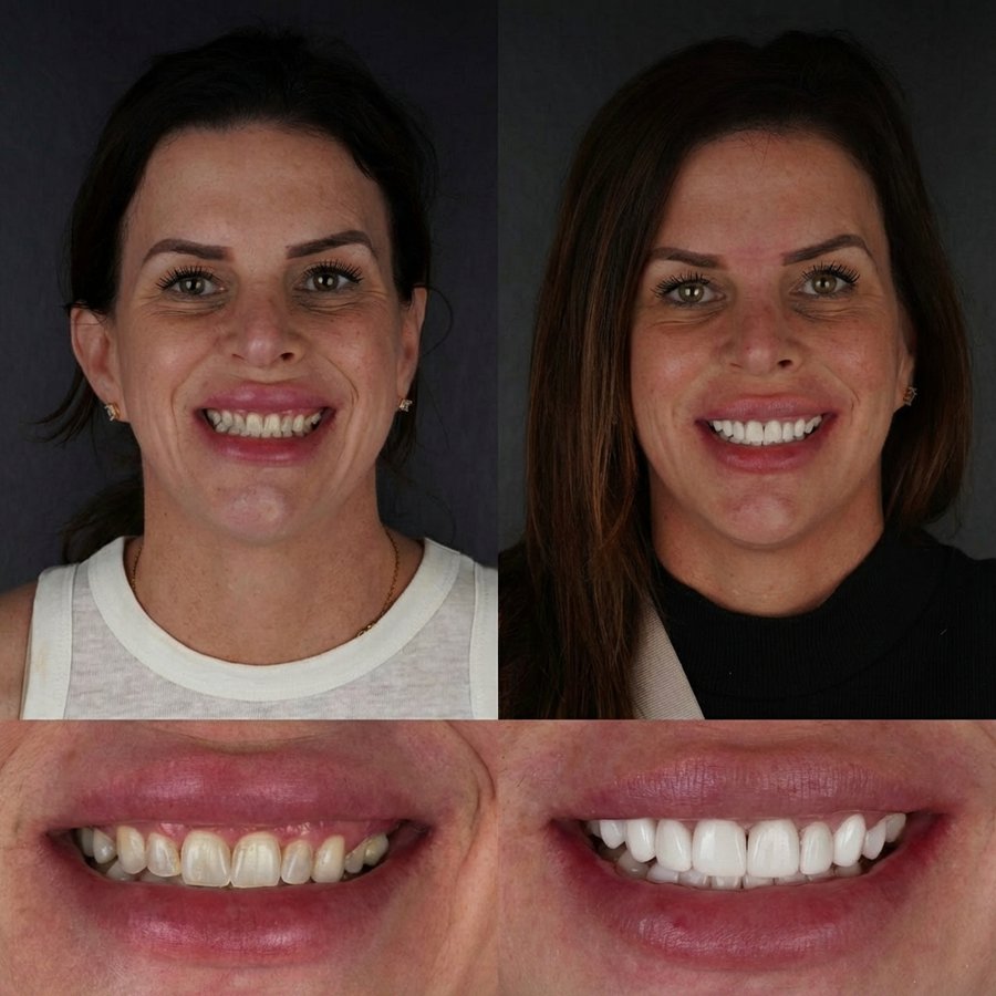 Smile Design with Porcelain Veneers and Gingivectomy