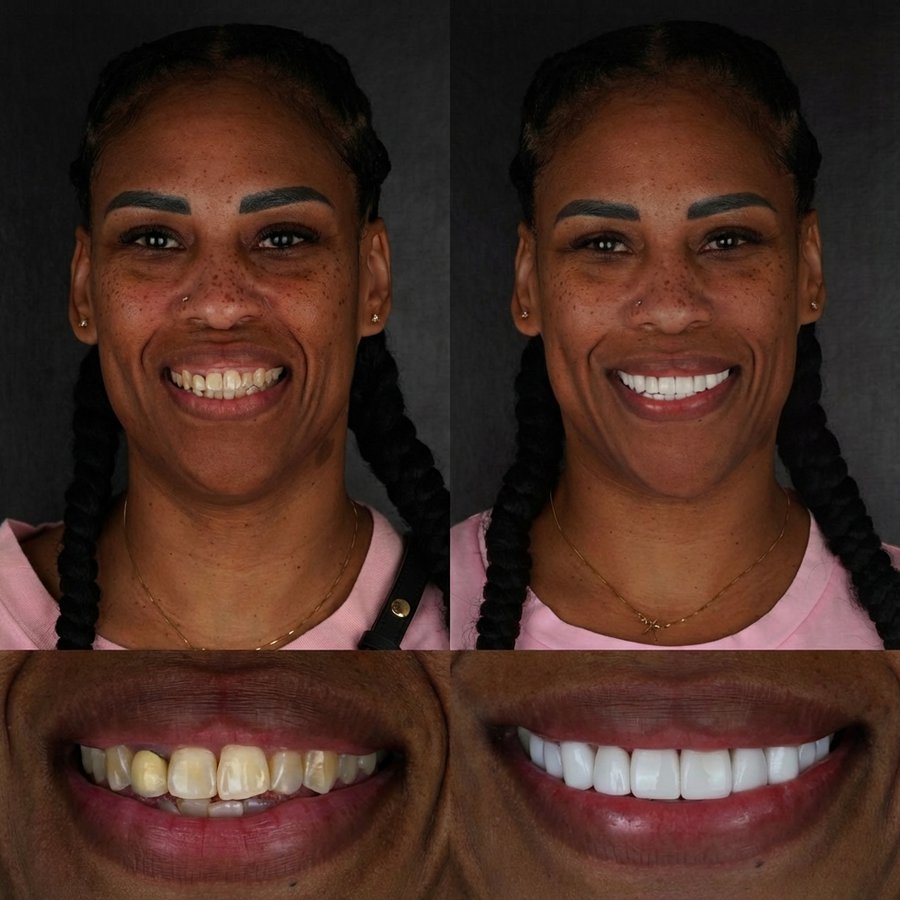 Smile Design with Porcelain Veneers