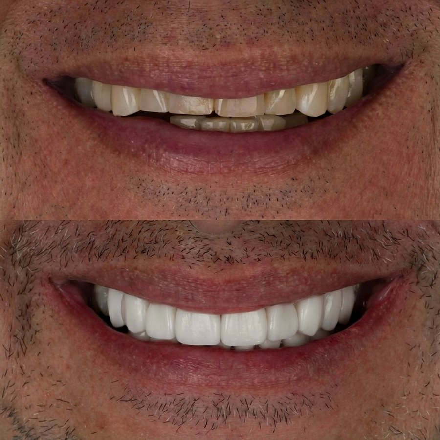 Smile Design with Porcelain Veneers