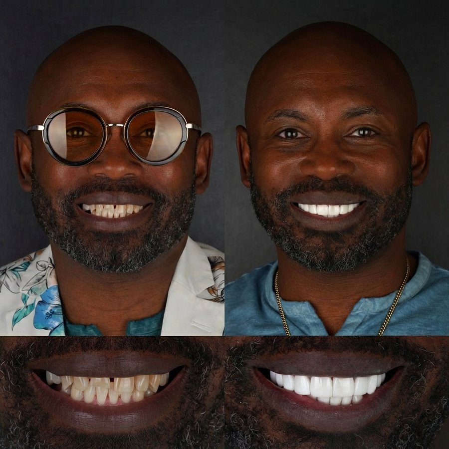 Smile Design with Porcelain Veneers