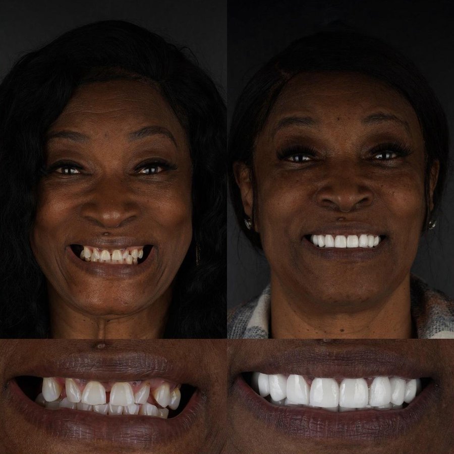 Smile Design with Porcelain Veneers