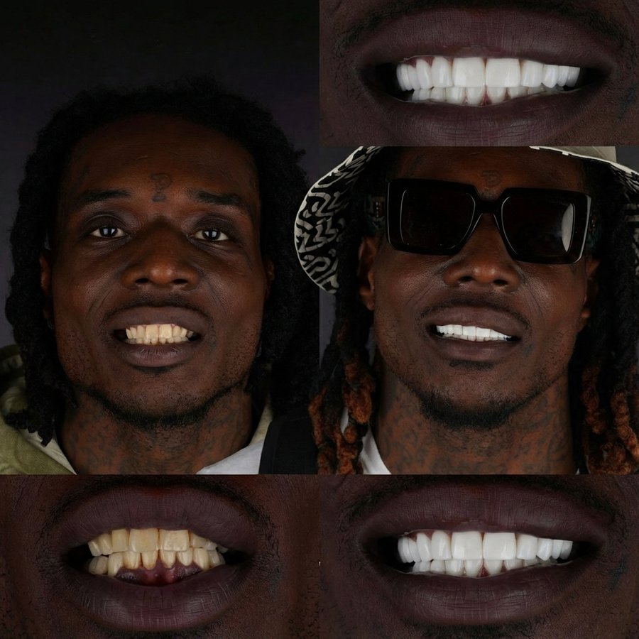 Smile Design with Porcelain Veneers