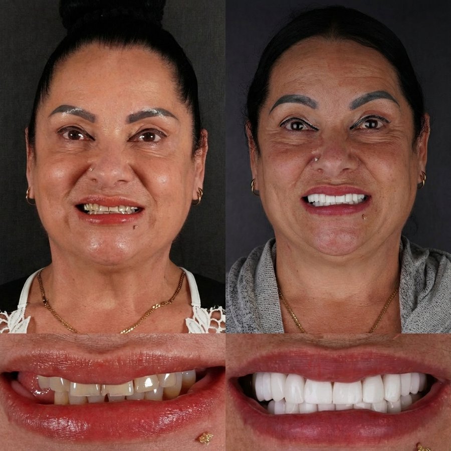 Smile Design with Porcelain Veneers
