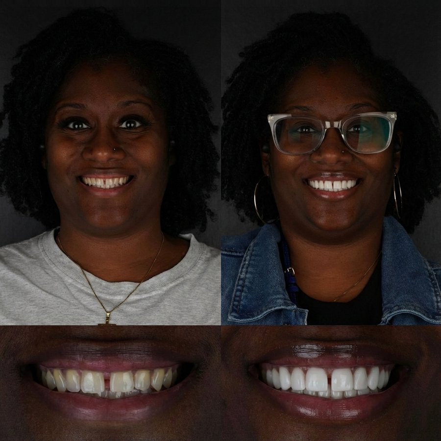 Smile Design with Porcelain Veneers