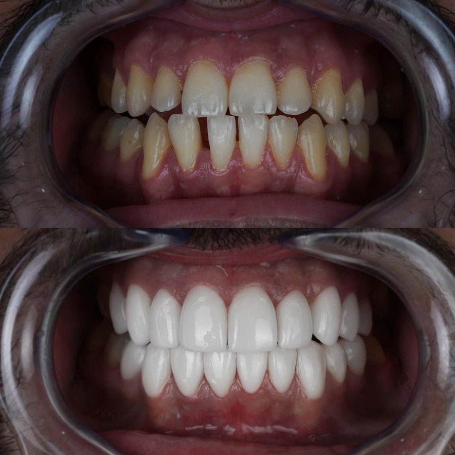 Smile Design with Porcelain Veneers