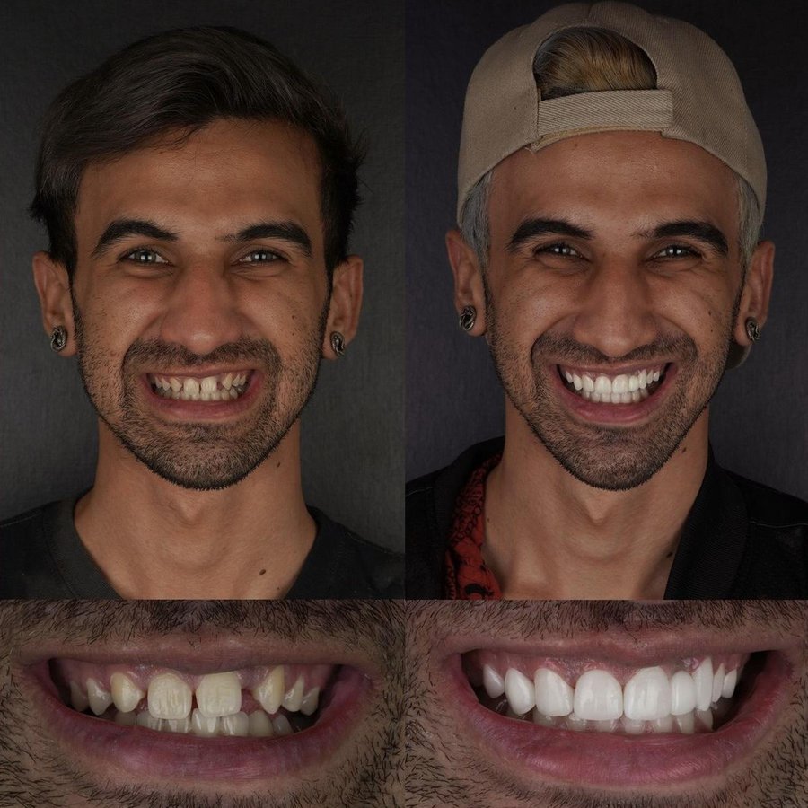 Smile Design with Porcelain Veneers and Dental Bridges