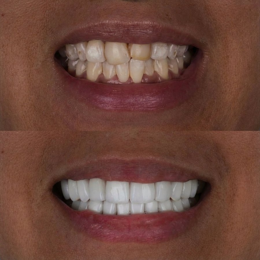 Smile Design with Porcelain Veneers