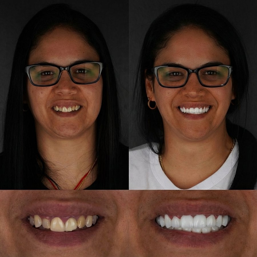 Smile Design with Porcelain Veneers