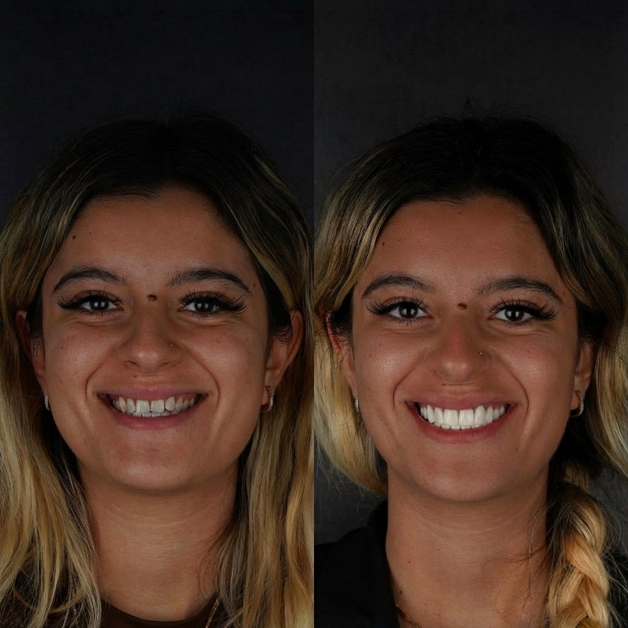 Smile Design with Porcelain Veneers