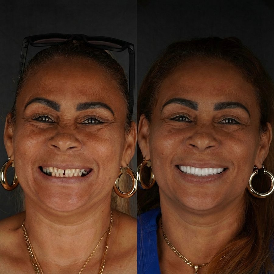 Smile Design with Porcelain Veneers