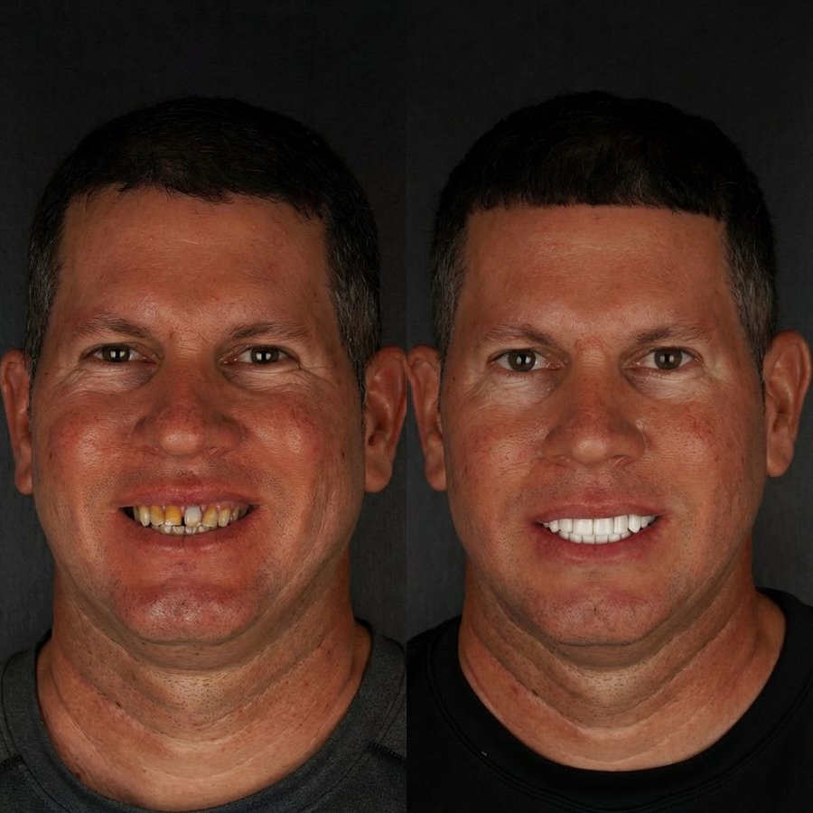 Smile Design with Porcelain Veneers