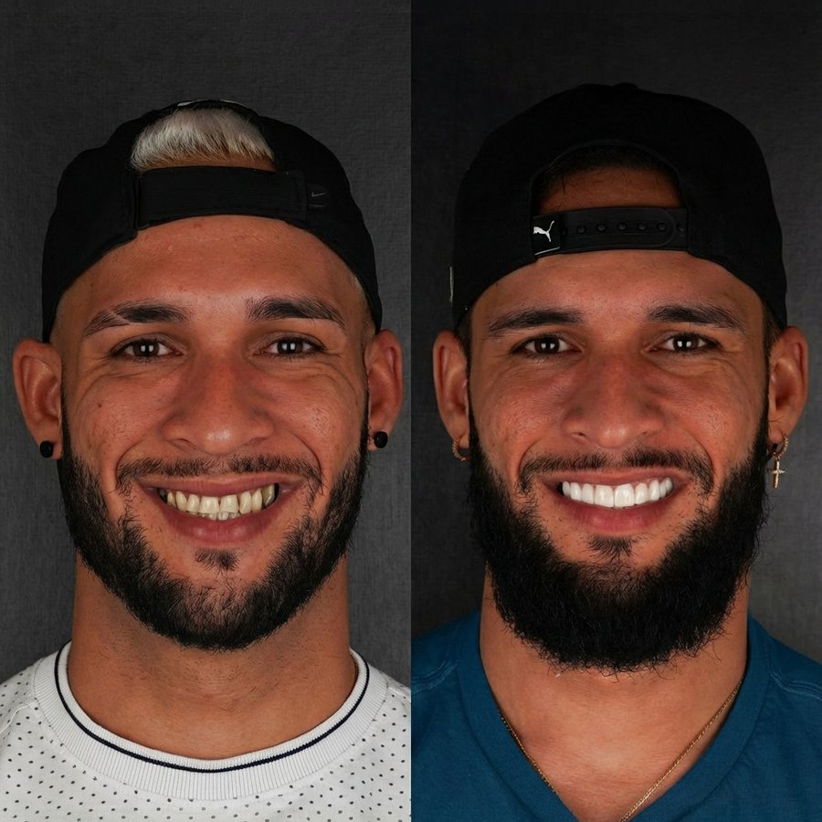 Smile Design with Porcelain Veneers