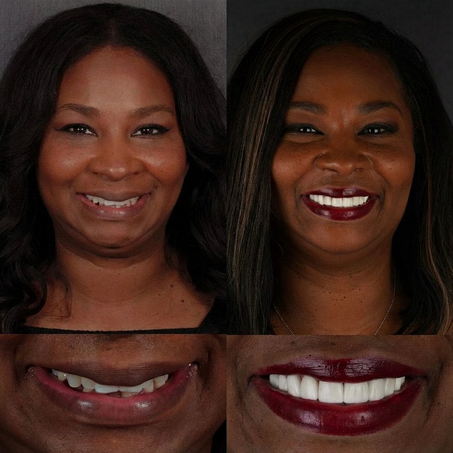 Smile Design with Porcelain Veneers