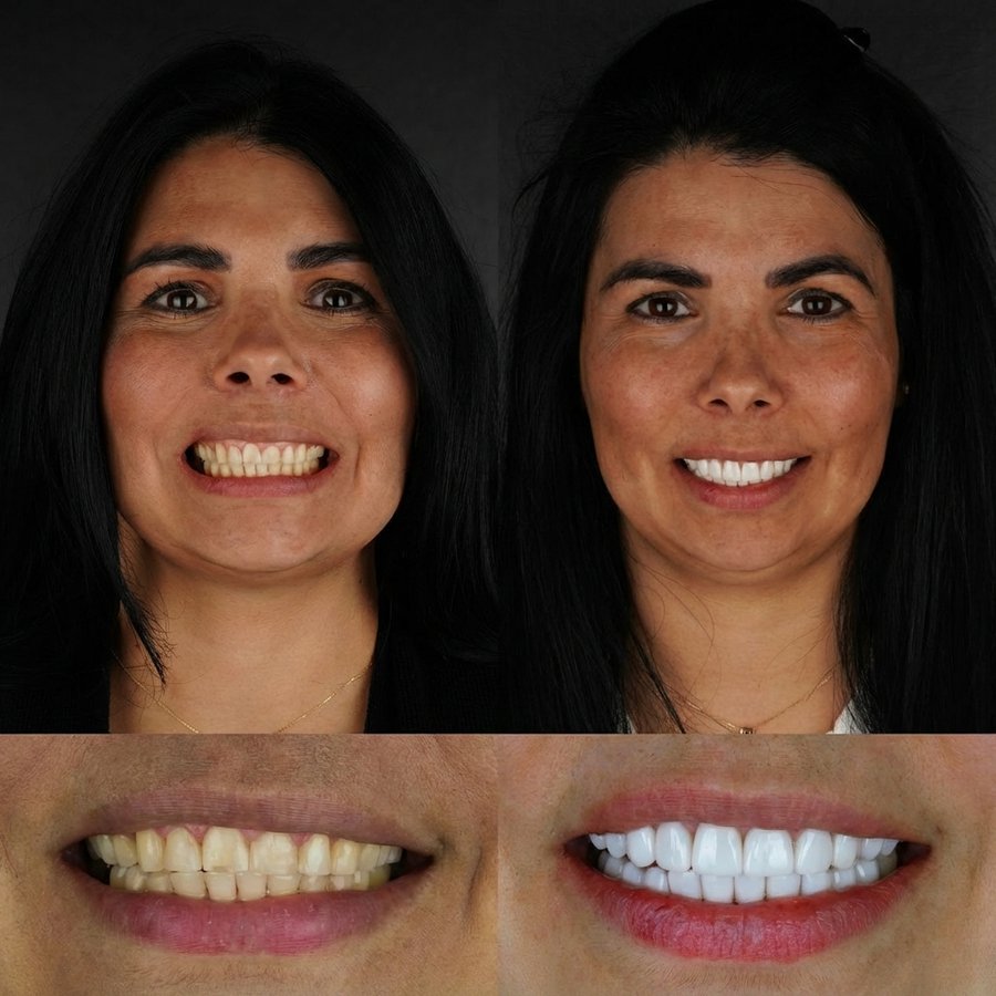 Smile Design with Porcelain Veneers