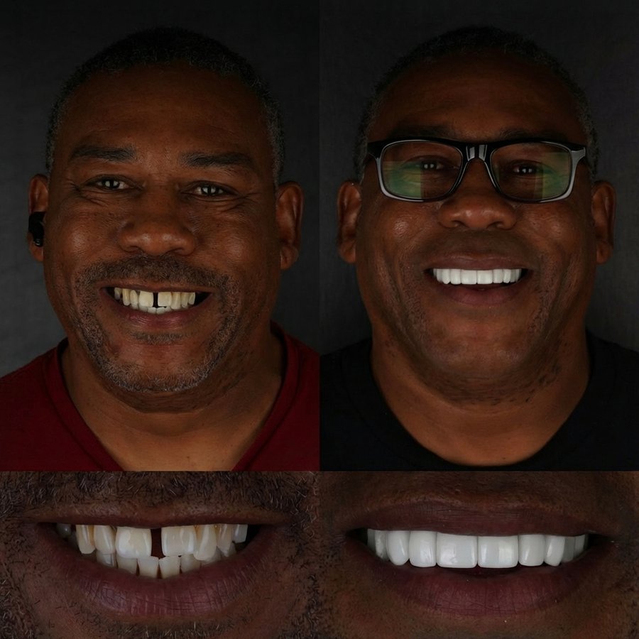 Smile Design with Porcelain Veneers