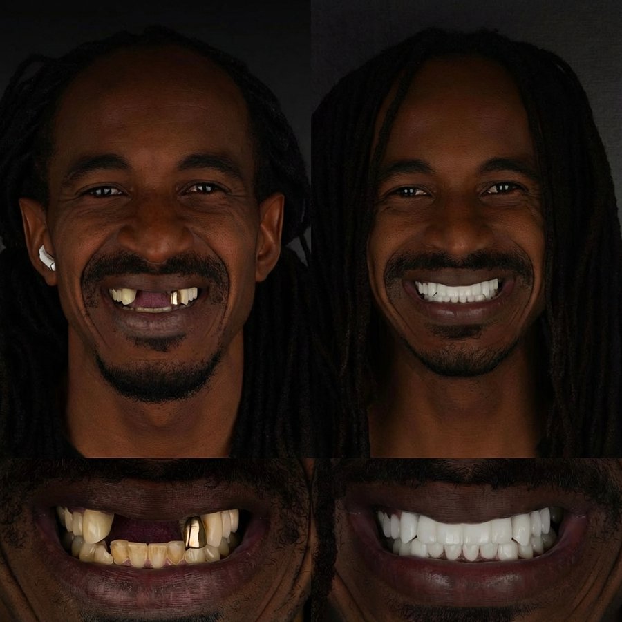 Smile Design with Porcelain Veneers and Dental Bridge